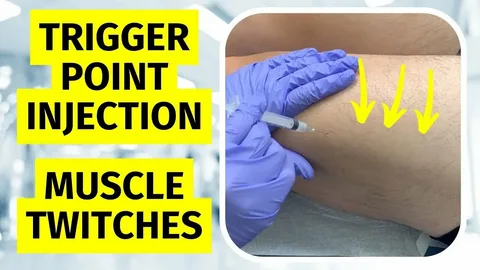 Trigger Point Injections: Benefits and How They Work