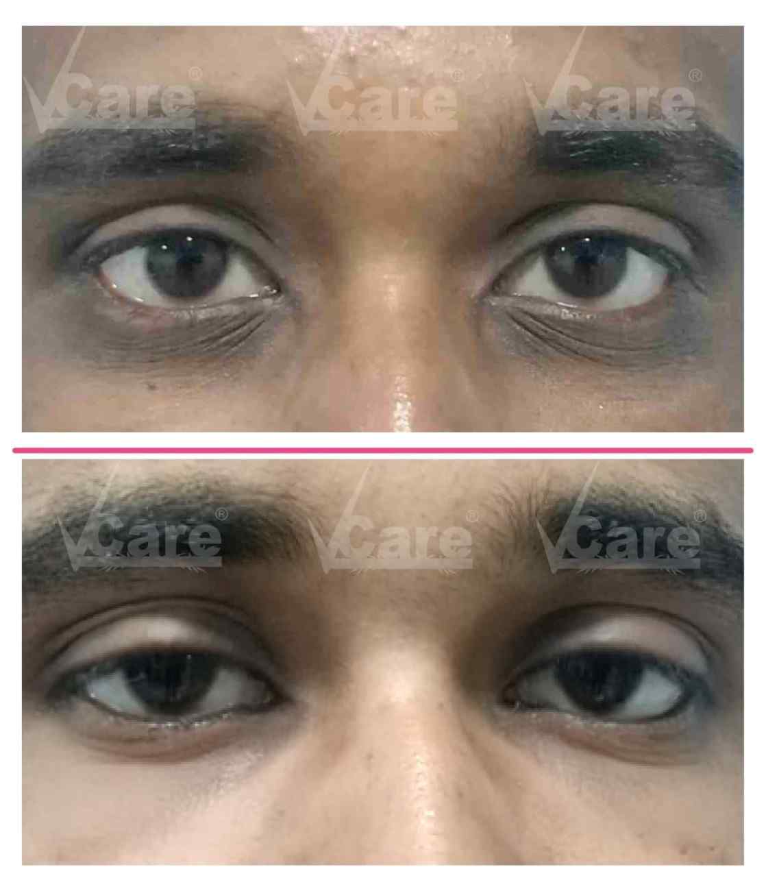 Dark Circle Removal Clinic: Expert Treatments