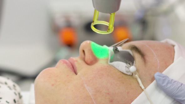 Laser Pigmentation Removal Clermont