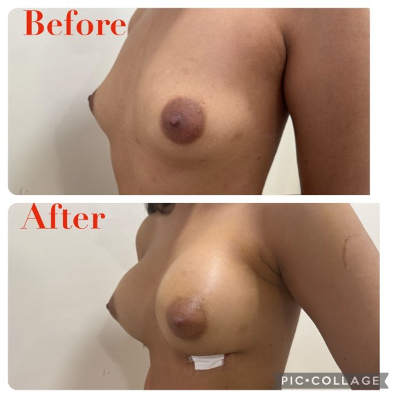 Chin Implants & Face Contouring Near me In Hyderabad