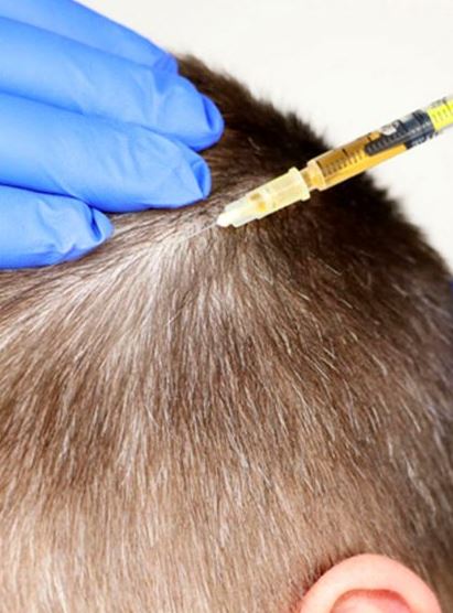 PRP – The Best Hair Fall Treatment in Karachi