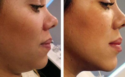 Before and After Botox Chin: How It Shapes Your Face