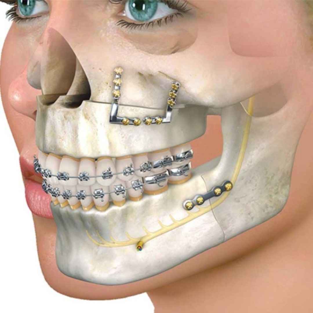 Wisdom Tooth Extraction Costs and Factors in Dubai