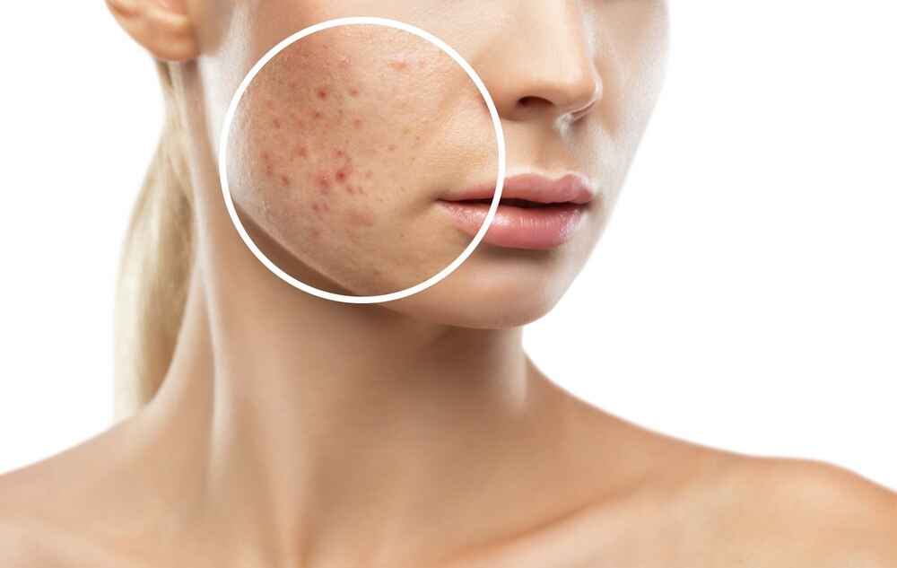 Scars Laser Treatment in Delhi Explained