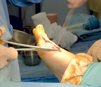 When Foot Surgery Becomes the Best Step Forward