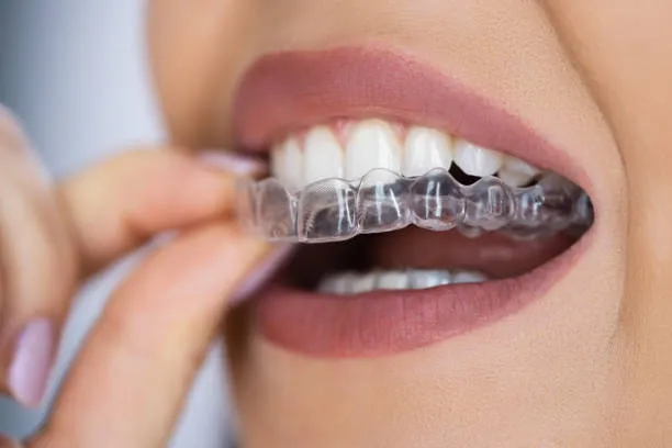Why London Patients Consider Invisalign