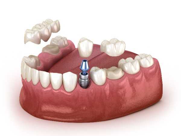 Dental Implants: Your FAQs Answered in Clapham