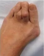 Bunion Treatment Real Solutions for Lasting Relief
