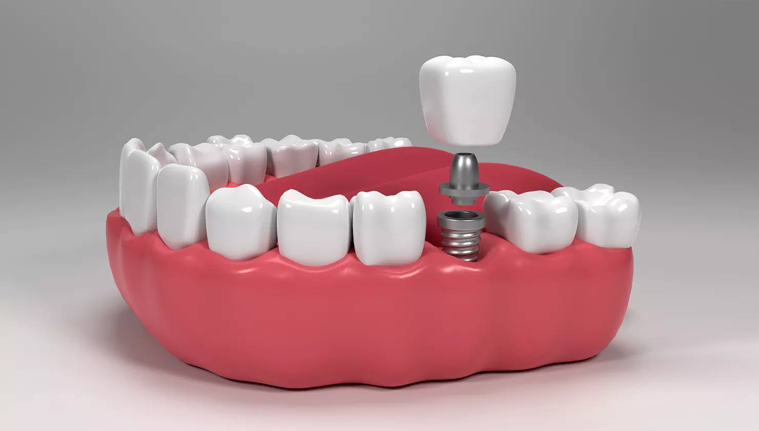 Dental Implants: Types, Procedures, Benefits and More