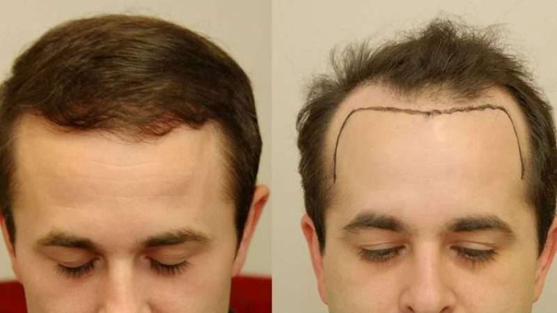 Hair Transplant in 2025: Techniques, Costs, Results