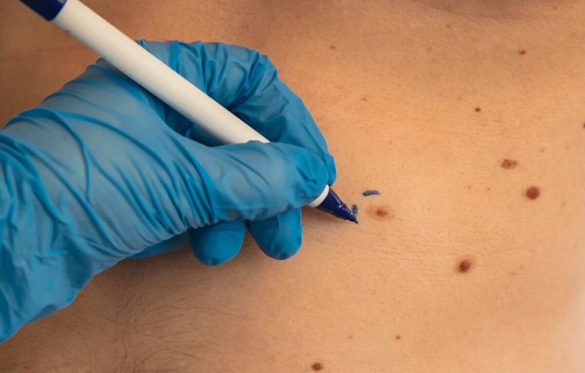 Anal Skin Tags: The Hidden Issue No One Talks About