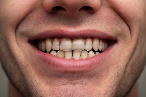 Why Teeth Shift After Braces: Orthodontic Relapse