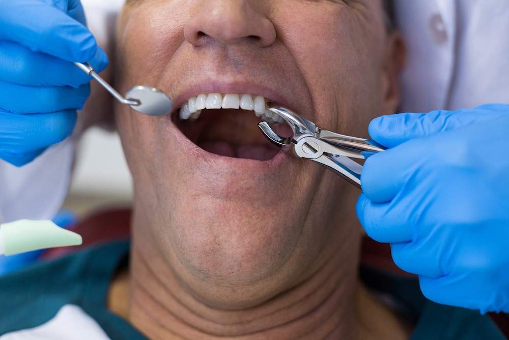 Wisdom Tooth Extraction for Pain Relief