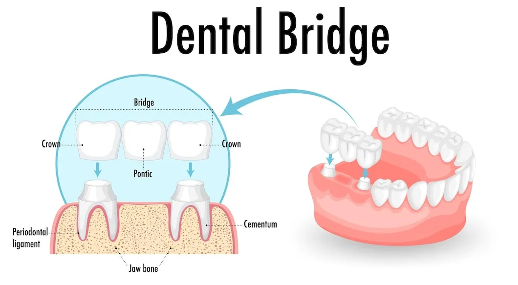 Cambridge Dental Bridge Procedure: Patient Guide