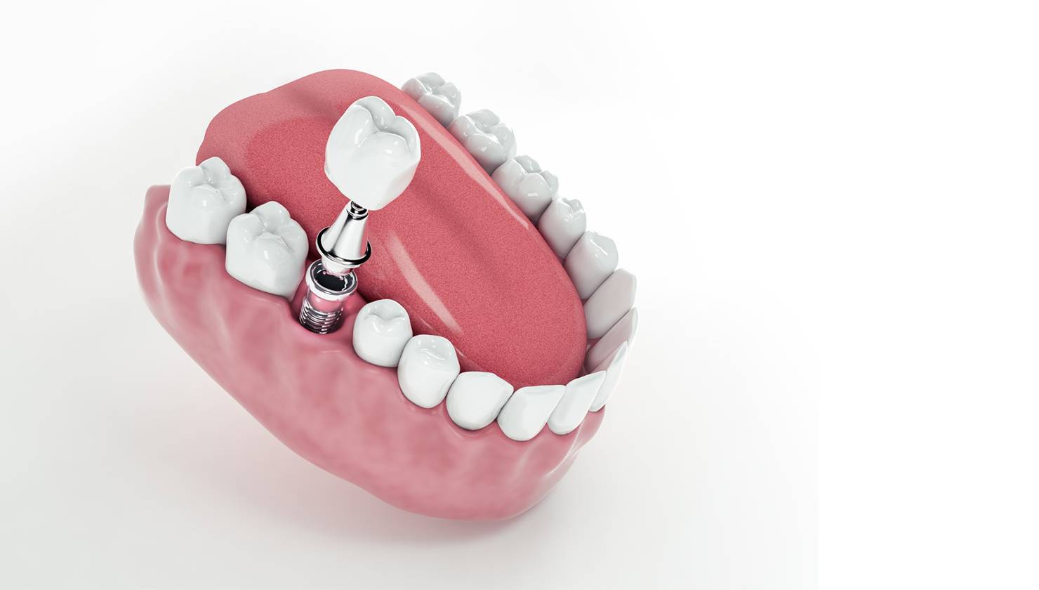 Risks of Getting Dental Implants Abroad