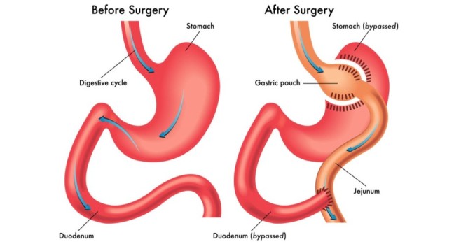 Understanding Laparoscopic Mini Gastric Bypass Surgery