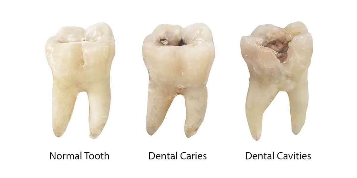 Why Do I Keep Getting Cavities?