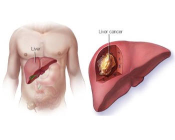Advanced Liver Cancer Treatment in Jaipur