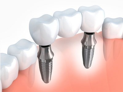 Tooth Implant Ancaster: Cost, Benefits & Recovery