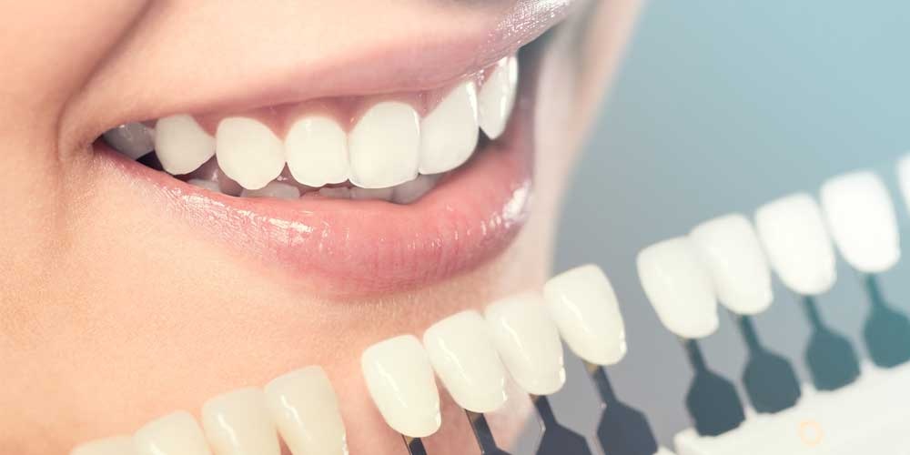 Dental Photography Secrets for Predictable Veneers