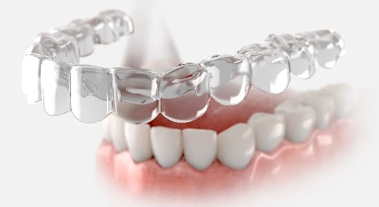 Invisalign Ancaster: Straighten Teeth Discreetly