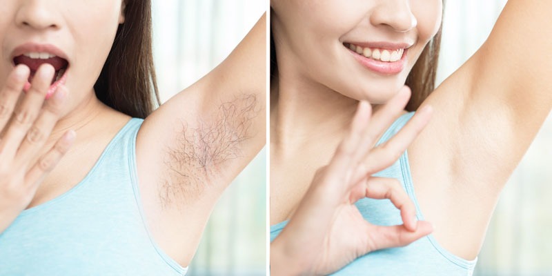 Achieving Results in Laser Hair Reduction in Delhi