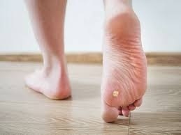 Why Do Black Patches Develop on Foot Soles