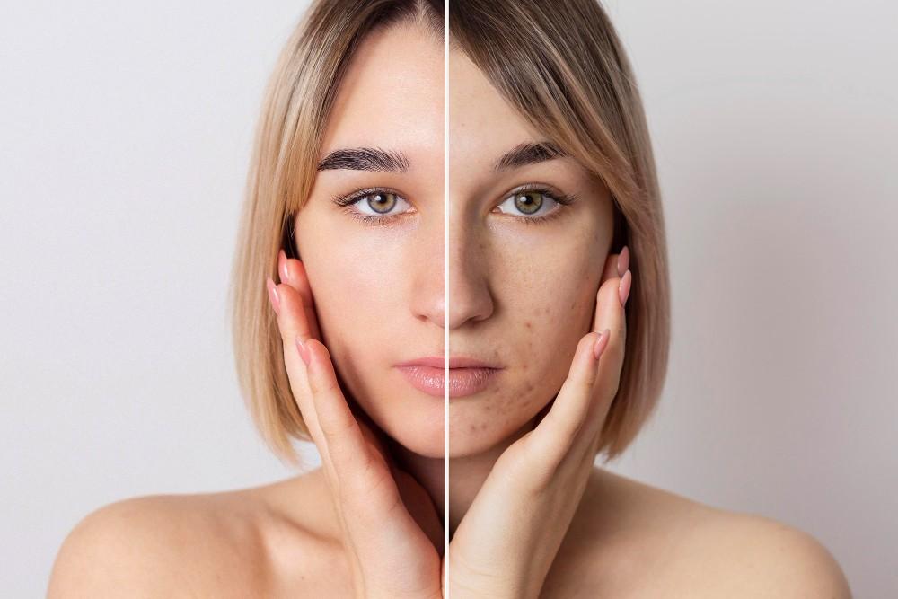 From Active Acne to Acne Scars: Prevent Skin Damage