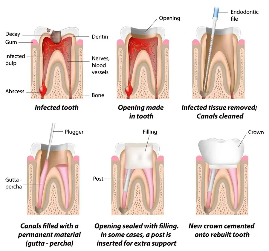 Endodontist London: Common Dental Problems They Treat