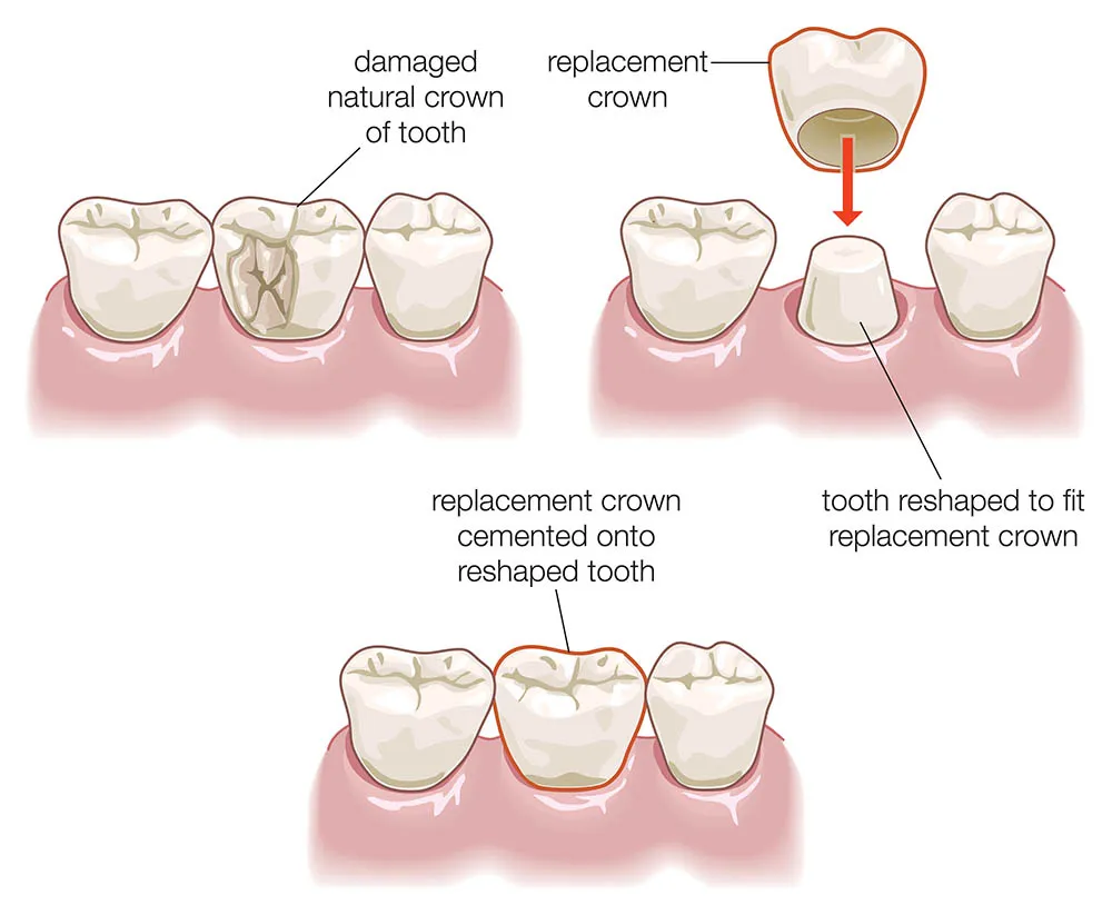 Dental Crowns Cambridge: When You Need One