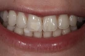 Dark Marks on Teeth When to See a Dentist