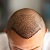The Ultimate  Guide to Permanent Hair Restoration