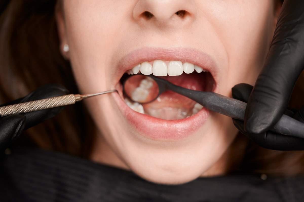 Understanding Wisdom Tooth Surgery in Georgetown