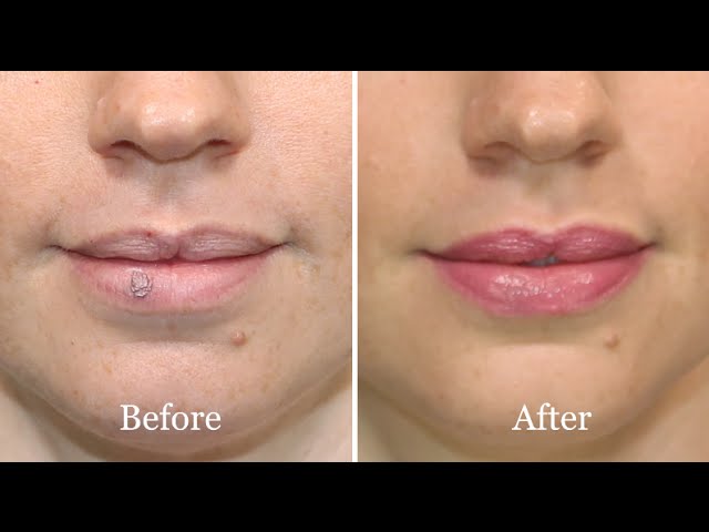 Choosing the Right Cold Sore Patches for You