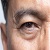 Achieving Youthful, Refreshed Eyes with Precision