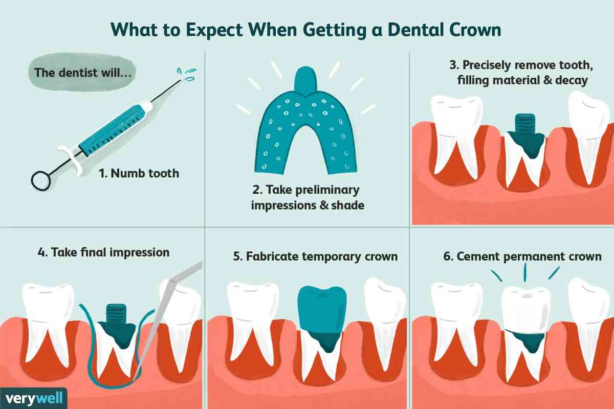 Dental Crown Cambridge: Results, Pain & Recovery