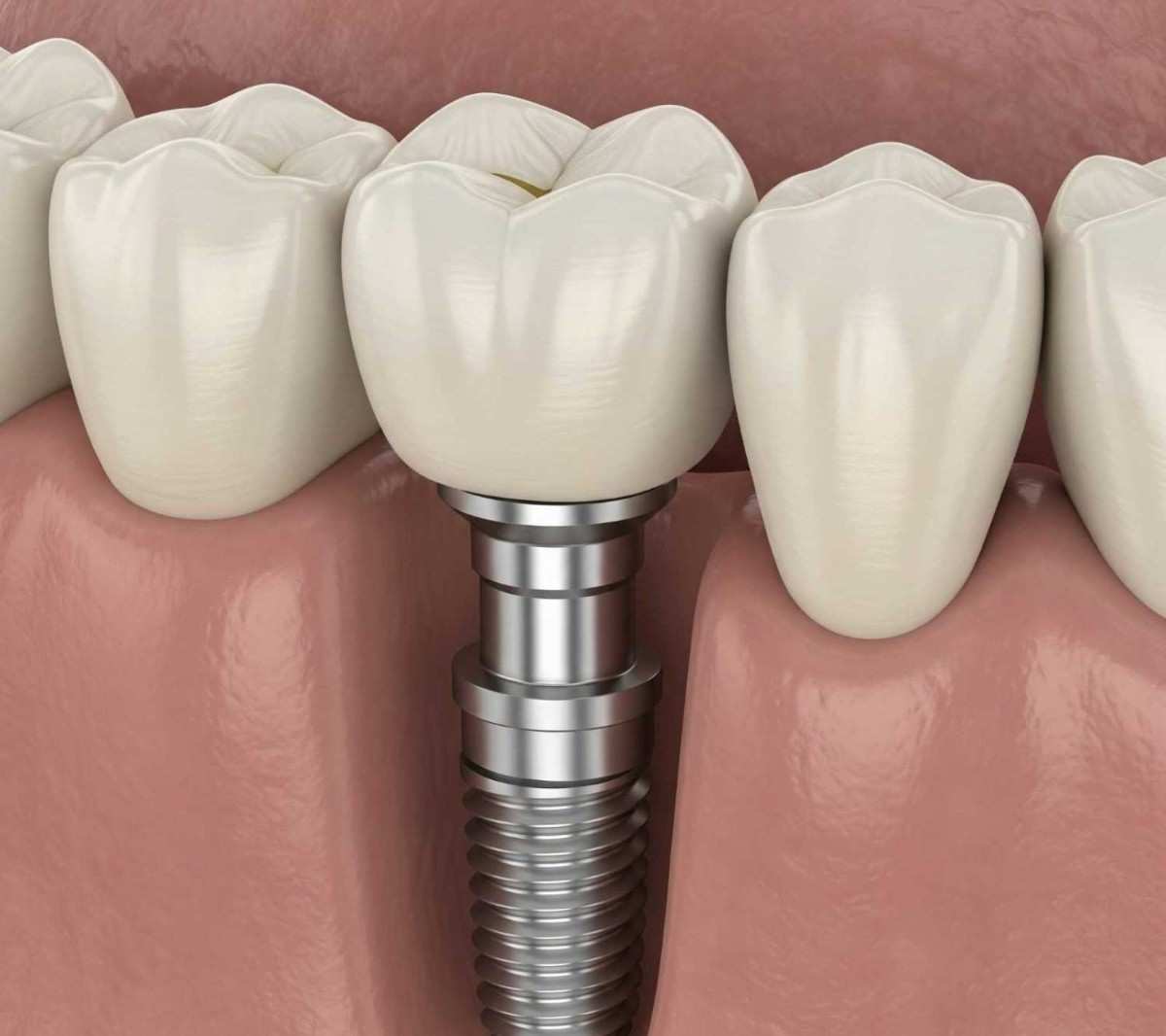 London Dental Implants: What You Need to Know