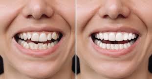 Dental Veneers: Everything You Need to Know