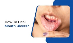 Glycerine for Mouth Ulcers  Natural Remedy Heals Faster