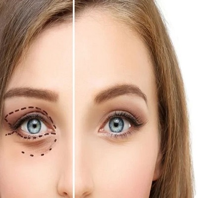 Eyelid Surgery in Riyadh for Long-Lasting Results