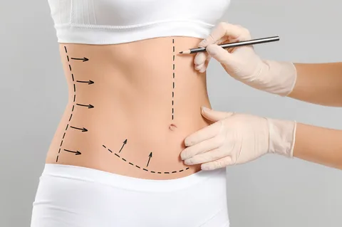 Transform Your Body with Liposuction in Islamabad