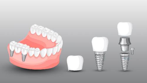 The Pros and Cons of All-On-4 Dental Implants