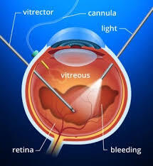 Retina Treatment in Chennai