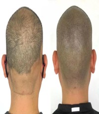 Thinning Hair Fix with Hair Density Micropigmentation