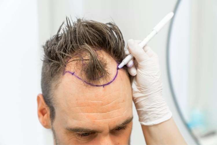 Good Candidate for Hair Transplant Surgery in Islamabad