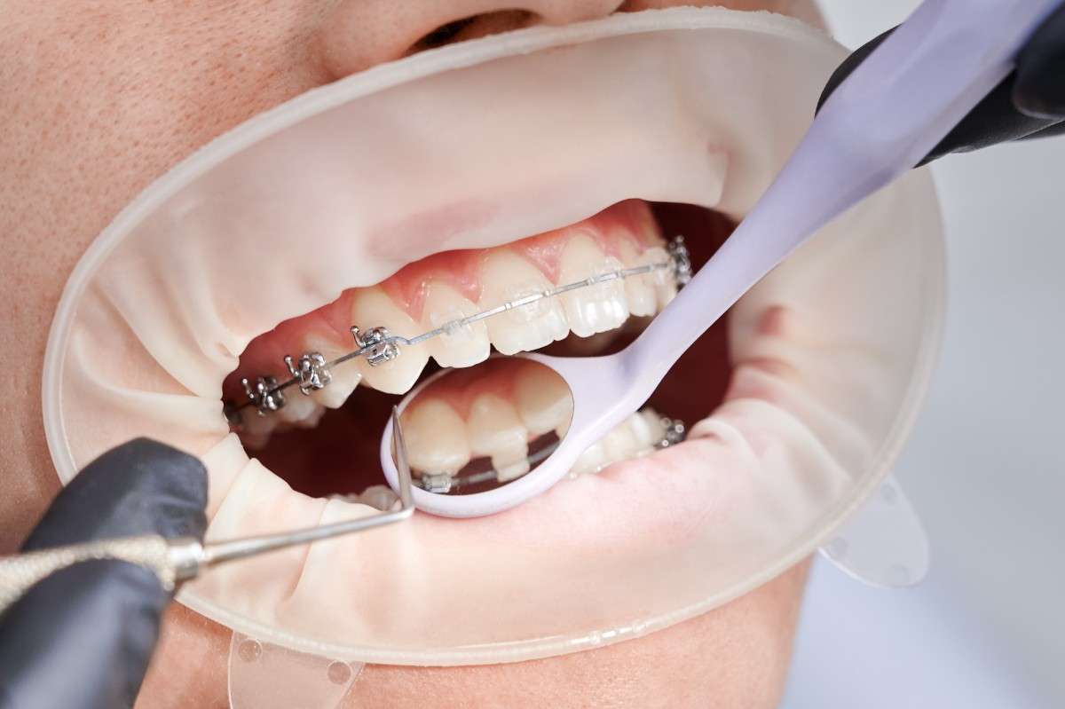 Bite Issues Treated by an Orthodontist in Georgetown