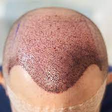 Dubai’s Most Trusted Hair Loss Clinics