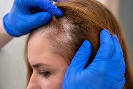 Smooth Regrowth: Alopecia Solutions in UAE