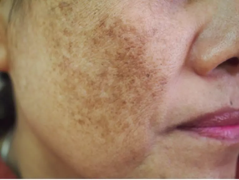 6 SURPRISING REASONS HYPERPIGMENTATION IN DUBAI