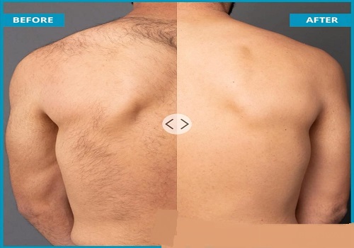 Important Steps Before And After Laser Hair Removal